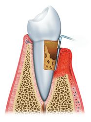 Advanced Periodontitis